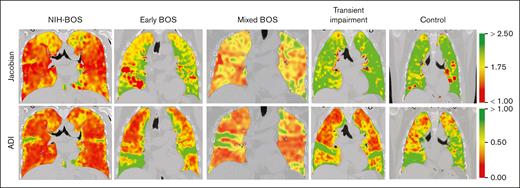 Representative coronal cuts of CT chest scans with strain metrics of individuals with NIH-BOS, early BOS, mixed BOS, transient impairment, and nonpulmonary cGVHD with normal lungs (control). Jacobian mean of 1 indicates no lung expansion and >1 indicates increasing lung expansion. ADI mean of 0 indicates no directional asymmetry of strain and >0 indicates increasing directional asymmetry of strain. The corresponding color range is displayed for illustration.