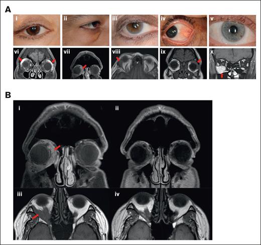 Representative patient images. (A) Representative images of patients 1 to 5 with KRAS-mutant isolated orbital histiocytosis. External photographs of the external adnexa and involved eye: eyelid edema and ptosis (i), conjunctival histiocytic infiltration (ii), exophthalmos, and scleral show (iii), lower eyelid swelling with xanthelasma (iv), exophthalmos and scleral show (v). MRI of representative patients: arrows showing bilateral diffusely enlarged lacrimal glands (vi), arrow showing thickening of the left lateral rectus (vii), arrow showing mass lesion involving the right lateral rectus muscle (viii), arrow showing infiltration and involvement of the lacrimal gland, superior muscle complex and lateral rectus (ix), and arrow showing bulky disease in the inferior orbit with diffuse involvement of the inferior rectus muscle (x). (B) Representative patient images demonstrating disease response to treatment in KRAS-mutant isolated orbital disease. T1-weighted MRI coronal image of patient 2 demonstrating predominantly inferior and medial histiocytosis infiltration of the right orbit before treatment (i) and marked response after cobimetinib treatment (ii). T1-weighted MRI axial image of patient 5 showing right infiltration of the inferolateral orbit with exophthalmos (iii), with marked improvement following intra-arterial chemotherapy with melphalan (iv).