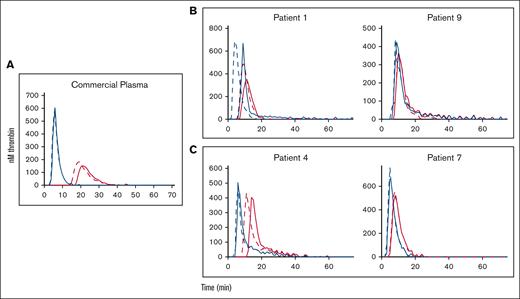 Effect of TFPI antibody on plasma thrombin generation in control and patient plasmas. Results are grouped as follows: commercial plasma (A), severe hemophilia (B), and mild hemophilia (C). Plasmas were incubated without TFPI antibody (solid red lines), with TFPI antibody (dashed red lines), with PS antibody (solid blue lines), and with TFPI + PS antibodies (dashed blue lines).