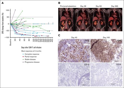 Tumor burden stabilization/regression and late conversion to CR with repeated dosing of durvalumab after JCAR014. (A) Spider plot of the change in the sum of the product of the perpendicular diameters of ≤6 target measurable nodes and extranodal sites (SPD) over time compared with the baseline prelymphodepletion according to best response at 3 months. ∗ represents patients with extranodal disease and no measurable target lesion. ‡ represents patients who converted to CR at 1 year. PET/CT (B) and immunohistochemistry (C) images at different timepoints in a patient with late conversion to CR with continued durvalumab despite evidence of CD19– escape. Images were taken at original magnification ×40.