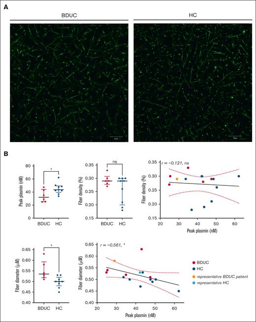 Fibrin network structure and its correlations with peak plasmin in patients with BDUC (n = 6) and HCs (n = 9). (A) Fibrin network structure of a representative patient with BDUC and an HC. The clot structure was analyzed using confocal microscopy (Zeiss LSM700) with a 63×/1.4 oil immersion objective. The settings included a pinhole aperture of 1 Airy unit (0.7 μm section), an image/frame size of 101.5 μm × 101.5 μm at a resolution of 1024 × 1024 pixels, and a pixel size of 0.1 μm. (B) Comparison of the fibrinogen levels, fiber density, and fiber diameters and the association of fiber density and diameter with the peak plasmin level in 6 representative patients with BDUC and 9 HCs. The 2 representative participants showed in panel A are marked as light red (BDUC) and light blue (HC). Significance is indicated as follows: ∗P < .05; ∗∗P < .01; ∗∗∗P < .001; ∗∗∗∗P < .0001; ns, not significant.