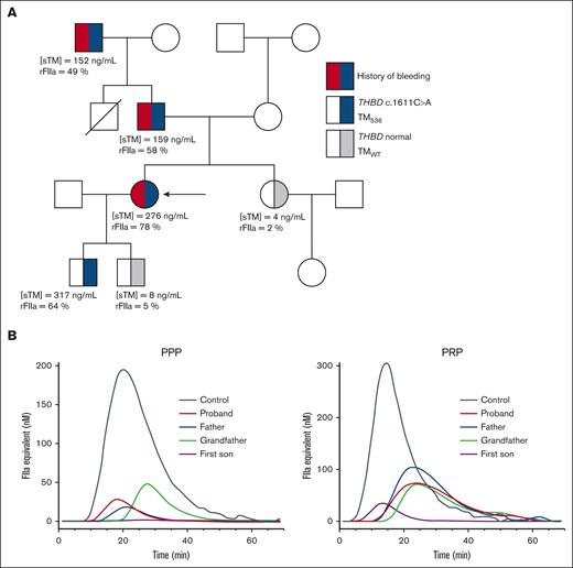 Patients’ description. (A) Pedigrees of the affected family. Squares denote males; circles denote females; slash denote deceased family member; solid red and black symbols represent family members with a history of bleeding and heterozygous carriers of the THBD variant (c.1611C>A giving TM536), respectively. The arrow indicates the proband. Plasma sTM concentrations were measured by enzyme-linked immunosorbent assay (ELISA; normal value <10 ng/mL). rFIIa was measured in the serum derived from the coagulation of plasma (normal value <30%). (B) FIIa generation assays were performed in PPP and PRP plasma from a control participant and 4 family members affected by the TM536 mutation. PPP, platelet-poor plasma; PRP, platelet-rich plasma; rFIIa, residual FIIa.