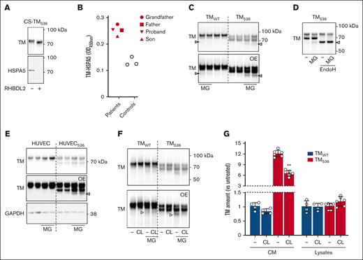 Degradation of TM536 by ERAD. (A) His-tagged CS-TM536 was overexpressed with inactive (−) or active (+) RHBDL2, soluble TM was purified by immobilized metal affinity chromatography from CM, and TM and HSPA5 were detected by immunoblot. (B) The TM-HSPA5 complex was detected by ELISA in the plasma from TM536 patients (patients) and healthy participants (controls). (C) Cells overexpressing TMWT or TM536 were treated or not with MG (5 μM; 17 hours) then TM in cell lystates was detected by immunoblot. (D) Cells overexpressing TM536 were treated with MG, cell lysates were deglycosylated with EndoH, and TM was detected by immunoblot. (E) TM detected by immunoblot in lysates of HUVEC and HUVEC536 treated with MG (5 μM; 17 hours; GAPDH, loading control). (F) Cells overexpressing TMWT or TM536 were treated with CL (10 μM; 17 hours) and MG, and TM was detected by immunoblot of cell lysates. (G) Cells overexpressing TMWT or TM536 were treated with CL, and then TM in CM and cell lysates were measured by ELISA. Values are mean ± SD expressed as fold change compared with TMWT without CL. Statistical analyses were performed using the Mann-Whitney test. ∗∗P < .01. Arrowheads on overexposed blots (OE) indicate bands that appear with MG132 treatment. MG, MG132.