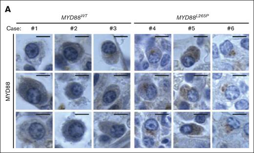 Implications of MYD88L265P murine model for human LPL/WM. (A) MYD88 expression in plasmacytoid lymphocytes in BM biopsies from LPL/WM patients without (n = 11) and with (n = 13) MYD88L265P mutation as evaluated by IHC staining. Three representative examples per each group are shown. Note punctate cytoplasmic staining of the MYD88L265P, but not WT, protein. Scale bars, 5 μm. T-cell infiltration of BM biopsies from LPL/WM patients without (n = 13) and with (n = 13) the MYD88L265P mutation.