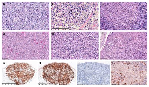 Cytologic and immunohistochemical features seen in IDCH. (A) A skin biopsy with characteristic ETV3::NCOA2 fusion showing cytologic features of LCH. However, unlike LCH, admixed eosinophils are absent. (B-C) Skin and lymph node biopsies from the same patient with primary IDCH, which harbors TET2 and KRAS mutations. Variation in cytologic features even in the same patient is noted in different sites. (D) Skin biopsy from a patients with secondary IDCH, who has underlying chronic myelomonocytic leukemia (CMML), showing mostly similar features seen in panels A,C with a relatively higher nucleus-to-cytoplasm ratio. (E) Lymph node biopsy from 1 of the excluded patients who was detected to have a KMT2A::MLLT1 fusion showing somewhat similar morphologic features seen in panel D. (F) Skin biopsy of a patient with primary IDCH showing epidermotropism, which was occasionally present in IDCH. (G-J) Representative case with ETV3::NCO2 fusion: lesional cells are diffusely positive for (G) CD1a and (H) BDCA1/CD1c; whereas negative for (I) Langerin/CD207 and (J) CSF1R/CD115.