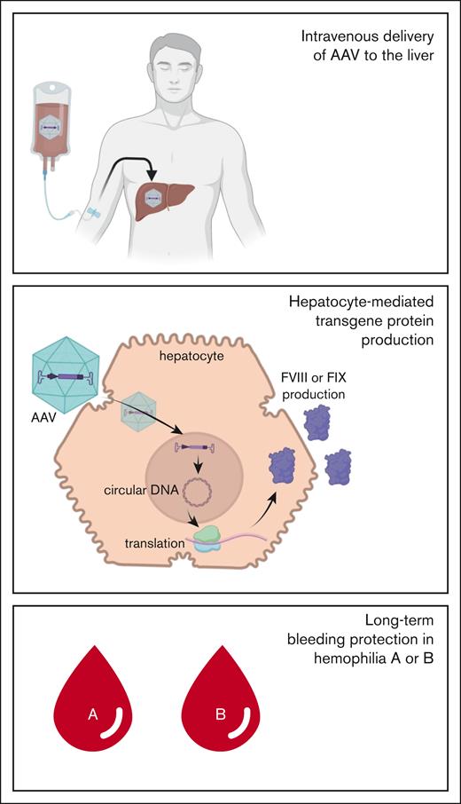 A single infusion of AAV-particles containing cDNA encoding factor VIII or factor IX allows for production of these proteins in hepatocytes, resulting in long-term bleeding protection in hemophilia A or B.