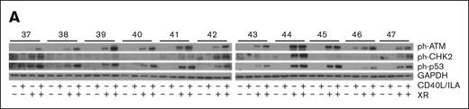 Activation of ATM associates with CD40L/IL-4 responses. (A) Western blots showing the effects of CD40L/IL-4 culture and XR (5 Gy) on levels of ph-ATM, ph-p53, and ph-CHK2. GAPDH is the loading control. Patient ID is given above (labeled 37 to 47) the autorads. Those samples that received XR are indicated.