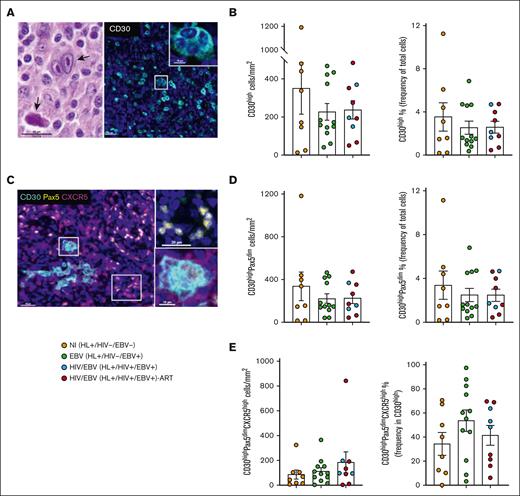 Viral infections do not change the cell densities of neoplastic CD30high cells. (A) A representative hematoxylin and eosin (H&E) image showing a binucleated HRS (top arrow) and a mummified (bottom arrow) cell in an EBV tissue (donor 16) (left). Representative fluorescence image of CD30high (cyan) staining in an EBV tissue (donor 17). Nuclei were visualized with DAPI. Inset shows a CD30high multinuclear HRS cell (right). (B) Bar graphs showing the cell densities (left) and frequencies (right) of CD30high cells in the 3 clinical pathological subgroups. (C) Representative fluorescence image of CD30high (cyan), Pax5high (yellow), and CXCR5high (magenta) staining in a NI tissue (donor 6). Nuclei were visualized with DAPI. Insets show CD30negPax5high (top) and CD30highPax5dimCXCR5high multinucleated HRS (bottom) cells. (D) Bar graphs depicting the cell densities (left) and frequencies (right) of CD30highPax5dim cells in the 3 clinical pathological subgroups. (E) Bar graphs depicting the cell densities (left) and frequencies (right) of CD30highPax5dimCXCR5high cells in the 3 clinical pathological subgroups. Statistical analysis was performed using Mann-Whitney test for panels B,D-E, and P values were corrected using FDR correction with q of 0.05.
