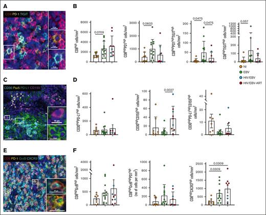Differential expression of coinhibitory network in EBV compared with HIV/EBV cHL. (A) Representative fluorescence images of CD8 (red), PD-1 (yellow), and TIGIT (cyan) expression in a NI tissue (donor 1). Nuclei were visualized with DAPI. Insets show a CD8 (top), PD-1high CD8 (middle), and TIGIThighCD8high (bottom) cell. (B) Bar graphs showing the cell densities of bulk CD8high and PD-1high, TIGIThigh, and PD-1highTIGIThighCD8high T cells in the 3 clinical pathological subgroups. (C) Representative fluorescence images of CD30 (cyan), Pax5 (yellow), PD-L1 (green), and CD155 (magenta) in a NI tissue (donor 6). Nuclei were visualized with DAPI. Insets show a CD155high cell (top) and a PD-L1high (bottom) cell. (D) Bar graphs showing the cell densities of CD30highPD-L1high, CD30highCD155high, and CD30highPD-L1highCD155high populations in the 3 clinical pathological subgroups. (E) Representative fluorescence images of CD8 (red), PD-1 (yellow), GrzB (green), and CXCR3 (cyan) in an EBV tissue (donor 17). Nuclei were visualized with DAPI. Insets show a CXCR3highCD8high (top) and a PD-1highGrzBhighCD8high T cell (bottom). (F) Bar graphs depicting the cell densities of GrzBhigh, GrzBhighPD-1high, and CXCR3highCD8high T-cell populations in the 3 clinical pathological subgroups. Statistical analysis was performed using Mann-Whitney test for panels B,D,F, and P values were corrected using FDR correction with q of 0.05.