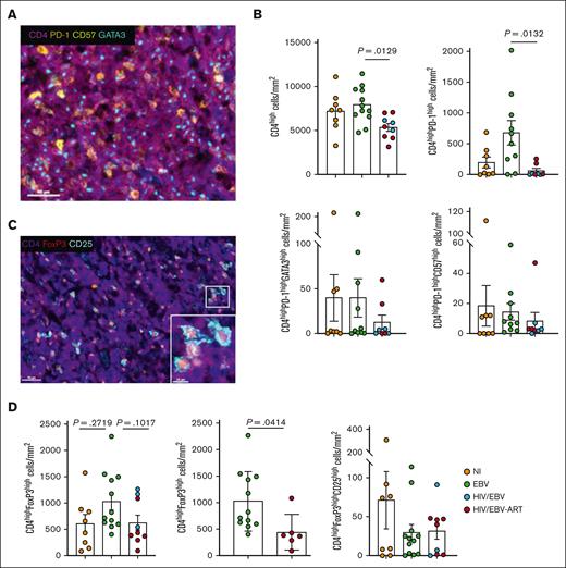 Contrary to EBV, HIV/EBV infection is associated with significantly reduced numbers of PD1high CD4 T cells in cHL TME. (A) Representative fluorescence images of CD4 (magenta), PD-1 (orange), CD57 (yellow), and GATA3 (cyan) in an EBV tissue (donor 20). Nuclei were visualized with DAPI. (B) Bar graphs showing the cell densities of bulk CD4 as well as PD-1high, PD-1highGATA3high, and PD-1highCD57high CD4high T cells in the 3 clinical pathological subgroups. (C) Representative fluorescence images of CD4 (magenta), FoxP3 (red), and CD25 (cyan) in an HIV/EBV tissue (donor 21). Nuclei were visualized with DAPI. Inset shows FoxP3highCD25highCD4high T cells. (D) Bar graphs showing the cell densities of CD4highFoxP3high and CD4highFoxP3highCD25high T-cell populations in the 3 clinical pathological subgroups. The comparison between EBV and HIV/EBV cART groups is shown too (middle panel). Statistical analysis was performed using Mann-Whitney test for panels B,D, and P values were corrected using FDR correction with q of 0.05. cART, combination antiretroviral therapy.