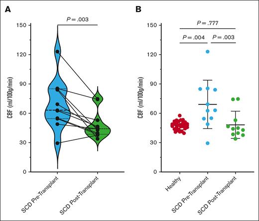 CBF changes before and after transplant and in relation to those in controls. (A) CBF changes in adults with SCD before and after HSCT. CBF significantly decreases after HSCT (P = .003). Individual participant changes are shown overlayed on the symbol and line graph, whereas group data are shown in violin plots, with the bolded dashed line showing the median and smaller dashed lines showing the upper and lower quartiles for participants before (blue plot) and after transplant (green plot). (B) Box-and-whisker plots of CBF shown in healthy adults (left; red dots) and in adults with SCD before transplant (middle; blue dots) and 1 year after transplant (right; green dots). CBF is significantly elevated in patients with SCD before transplant (P = .004) and reduces to levels similar to healthy adults after transplant (P = .777).