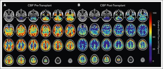 CBF changes before and after transplant shown in axial blood flow maps in MNI space. Ascending axial slices of CBF (mL/100 g per minute) maps averaged across participants with SCD before (A) and after (B) HSCT. Maps are shown overlayed on standard (Montreal Neurological Institute) space anatomical T1 images.