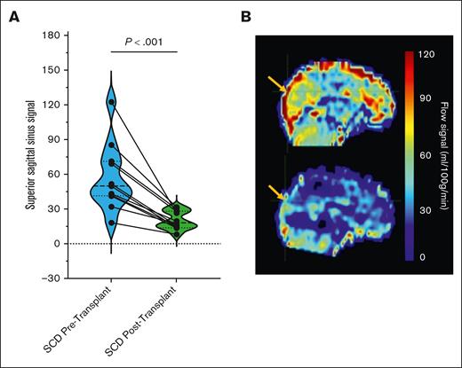 Superior sagittal sinus (SSS) flow changes from before to after transplant shown in graphical display and blood flow maps. (A) Individual subject changes are shown overlayed on the symbol and line graph, while group data are shown in violin plots with the bolded dashed line showing the median and smaller dashed lines showing the upper and lower quartiles for subjects pretransplant (blue plot) and posttransplant (green plot). (B) Signal change in the SSS quantified and shown in sagittal views of mean CBF shunting effect before transplant (top) and following transplant (bottom). Blood flow maps have been registered to standard (Montreal Neurological Institute) space; yellow arrows indicate the area of the sagittal sinus surveyed.