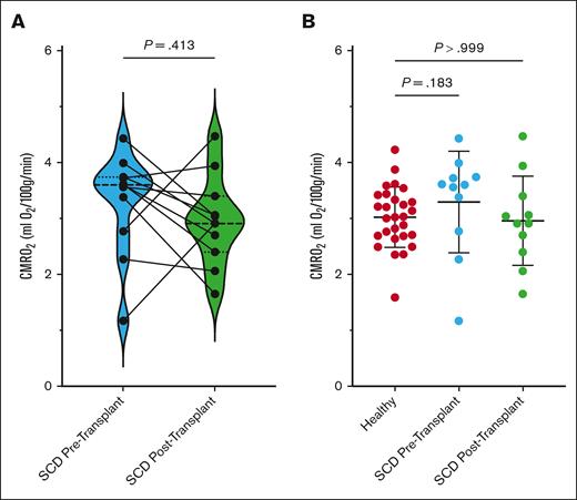 CMRO2 changes before and after transplant and compared with healthy controls. (A) CMRO2 changes in adults with SCD before and after HSCT (haplo-BMT). Individual participant changes are shown overlayed on the symbol and line graph, whereas group data are shown in violin plots with the bolded dashed line showing the median and smaller dashed lines showing the upper and lower quartiles for subjects before (blue plot) and after transplant (green plot). (B) Box-and-whisker plots of CMRO2 shown in healthy adults (left; red dots) and in adults with SCD before transplant (middle; blue dots) and 1 year after transplant (right; green dots). CMRO2 does not show significant differences between controls and patients with SCD either before transplant (P = .18) or after transplant (P = .99).