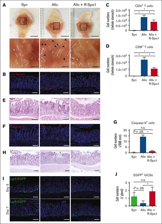 R-Spo1 mitigates GVHD-induced GSC injury. (A-D) Lethally irradiated B6 (Syn) or B6D2F1 (allo) mice received transplantation with bone marrow cells plus splenocytes from B6-Lck-cre donors on day 0. Allogeneic recipients were treated with R-Spo1 or PBS on days −3 to −1 and days +1 to +3. The stomach was harvested on day +7. (A) Macroscopic images of the gastric mucosa (top). The area in the black squares were magnified and shown in the bottom of the original images. Arrow heads indicate the erosions observed macroscopically. Bars, 5 mm (top) and 1 mm (bottom). (B) Immunofluorescent images of LcktdTomato+ T cells (red) in the gastric mucosa with DAPI nuclear staining (blue). (C-D) Numbers of CD4+ and CD8+ T cells infiltrated in the gastric mucosa. (E-J) Lethally irradiated B6D2F1-Lgr5-EGFP-creER mice received transplantation from B6D2F1 (syn) or B6 (allo) donors on day 0 and treated with R-Spo1 or PBS, as in panel A. On day +7, stomach was harvested. H&E staining (E), immunofluorescent images of cleaved caspase-3 (F) (red) with DAPI nuclear staining (blue), numbers of cleaved caspase-3 (G), PAS staining (H), immunofluorescent images of EGFP+ Lgr5+ GSCs (green) (I), and numbers of Lgr5+ GSCs (J) in the stomach. (H) Red arrow heads represent disrupted mucin layer. (B,E,F,H,I) Bars represent 100 μm. Data from 2 experiments were combined and shown as means ± standard error of the mean (n = 4-5 per group). ∗P < .05.