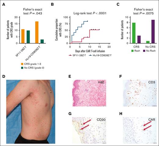 CRS and rashes after 5F11-T. (A) A significantly lower proportion of patients experienced CRS after receiving 5F11-T than those in a prior trial of Hu19-CD828Z-Ts for patients with B-cell non-HL. (Fisher exact test, P = .043). (B) Patients receiving 5F11-T had lower rates of CRS, and CRS tended to start later, than in our prior experience with Hu19-CD828Z-Ts (log-rank test, P < .0001). (C) Of the patients receiving 5F11-T, a greater proportion of patients who had CRS also developed a rash than patients without CRS (Fisher exact test, P = .0075). (D) Patient 16 in cohort 1 developed a diffuse, grade 3 maculopapular rash starting on day +7 after 5F11-T infusion. The photo was taken on day +8. (E) Patient 16 in cohort 1 underwent a skin biopsy of the rash on day +7. Hematoxylin and eosin (H&E) staining at 20× original magnification reveals a spongiotic dermatitis with a lymphohistiocytic infiltrate and perivascular inflammation. (F) CD3 staining at 20× original magnification demonstrates superficial and deep perivascular T cells. (G) CD30 staining at 40× original magnification shows CD30-expressing lymphocytes in the dermis. No keratinocytes were found to be CD30+. (H) IHC staining for the CAR at 40× original magnification reveals scattered CAR+ cells in the dermis.