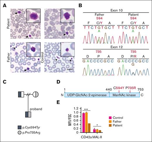 Identification of GNE compound heterozygote variants in a patient with macrothrombocytopenia. (A) Representative images of Giemsa staining of peripheral blood smears from the patient (age 16), the patient’s father (age 40), and a healthy individual (age 28) as normal control who has no family relationship with the patient or his other family members. The size of patient’s platelets was nearly 3 times larger than that of the normal control. Arrows indicate enlarged platelets. Arrowheads indicate normal platelets. Black boxes indicate platelets with higher magnification. Scale bar, 10 μm. (B) Genomic DNA sequences of exon 10 and exon 12 of GNE in father- and patient-derived blood cells. Letters and numbers in red indicate mutated residues and sites in the GNE protein sequence, respectively. (C) Pedigree of the family. The filled square indicates the patient, who is the proband, and the half-filled square and circle indicate heterozygous father and mother, respectively. (D) Schematic domain structure of GNE carrying combined missense mutations in the patient. (E) MFI of MAL-II and platelet surface marker CD42a on peripheral platelets from the patient, patient’s father and a healthy individual as normal control (the same individual as in Figure 1A), respectively. MFI, mean fluorescence intensity; FSC, forward scatter; MAL-II, Maackia amurensis lectin II, binds to α-2,3 linked sialic acid. ∗P < .05; ∗∗∗P < .001.