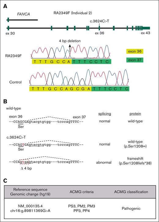 FANCA variant c.3624C>T generates a cryptic splice site. (A) Schematic of FANCA alleles in fibroblasts from individual 2. A large deletion extending from exons 31 to 43 is present on 1 allele. The other allele is c.3624C>T (top). Traces from Sanger sequencing of the reverse transcription PCR product amplified from the region around FANCA exon 36 using RNA derived from the RA2349 cell line. The c.3624C>T variant appears to create an aberrant splice donor site that is 4 bp upstream of the canonical exon 36 donor site, predicted to lead to a frameshift (bottom). (B) Schematic showing that the sequence around the c.3624C>T variant, predicted to be synonymous, affects RNA splicing. (C) Classification of the c.3624C>T variant according to American College of Medical Genetics and Genomics ACMG criteria.