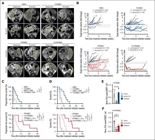 Cd79b p.Y195H confers ibrutinib sensitivity in vivo. MBC, 79-MBC, PPMBC, and 79-PPMBC mice were monitored for lymphoma development by MRI and upon tumor diagnosis either left untreated or treated with ibrutinib. (A) MRI images illustrate a baseline scan and after 3 weeks of ibrutinib treatment for a representative animal of each genotype and cohort. (B) Volume changes of target lesions over time are visualized for all 4 genotypes. Progression-free survival (C) and OS (D) is illustrated . (E), (F) PLA detecting the proximity of MYD88 and CD79B was done on FFPE tissue sections of ibrutinib relapsed 79-MBC and 79-PPMBC lymphomas and compared with PLA counts of treatment-naïve lesions of the same genotype, as well as tumor samples isolated from acutely treated animals (30 mg/kg orally daily for 3 days). ∗P ≤ .05, ∗∗P ≤ .01, ∗∗∗P ≤ .001, ∗∗∗∗P ≤ .0001; (C-D) Log-rank test. (E-F) Welch 2-tailed t test, corrected for multihypothesis testing (Benjamini-Hochberg).