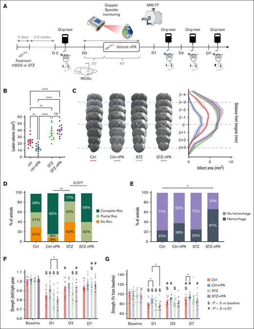 Chronic hyperglycemia induces rtPA resistance and increases HT in a mouse model of thromboembolic stroke. (A) Schematic representation of the experimental protocol. (B) Quantification of ischemic lesion volume, 24 hours after MCAo assessed by T2-weighted imaging (7T MRI) in saline or rtPA treated (10 mg/kg; Actilyse, 10% bolus, 90% perfusion during 40 minutes) on nonhyperglycemic mice (Ctrl) or on hyperglycemic mice (STZ). Individual values, means, and standard error of the mean (SEM) are plotted; 23.38 mm3 for Ctrl group (n = 13); 12.88 mm3 for Ctrl-rtPA group (n = 13); 36 mm3 for STZ group (n = 12); 39.58 mm3 for STZ-rtPA group (n = 12). Ordinary 1-way analysis of variance (ANOVA) (P < .01); Tukey test for multiple comparisons (∗∗P < .01; ∗∗∗∗P < .0001). (C) Representative T2-weighted 7T MRI brain images (left) and representation of the lesion distribution around bregma (right), 24 hours after MCAo in Ctrl, Ctrl-rtPA, STZ, and STZ-rtPA groups. (D) Percentage of angiographic scores 24 hours after MCAo assessed by FLASH TOF 2D imaging (7T MRI) in Ctrl (n = 13), Ctrl-rtPA (n = 12), STZ (n = 12), and STZ-rtPA (n = 12) groups. No recanalization = complete occlusion (orange); partial recanalization = incomplete filling of the distal bed (light green); and complete recanalization = complete filling of the distal bed (dark green). Kruskal-Wallis test (P < .01); Dunns test for multiple comparisons (∗∗P < .01). (E) Proportion of HT per groups, 24 hours after MCAo assessed by T2∗-weighted imaging (deoxyhemoglobin; 7T MRI) in Ctrl (n = 13), Ctrl-rtPA (n = 13), STZ (n = 12), and STZ-rtPA (n = 12) groups. Fisher exact tests between groups (∗P < .05). (F) Quantification of the specific left paw–strength deficit measured by grip-test ratio (strength of left/right paws) of Ctrl, Ctrl-rtPA, STZ, and STZ-rtPA groups (n = 12) before MCAo and on days 1, 3, and 7 after MCAo. Data were assessed in grams. Results are represented in mean ± SEM; 2-way ANOVA: time × group effect = 0.0211; Tukey test for multiple comparison (∗P < .05 between groups at each time; $P < .5 vs baseline for each group: impact of Stroke; #P < .5 vs day 1 for each group: recovery). (G) Quantification of the global strength deficit measured by grip-test of forepaws of Ctrl, Ctrl-rtPA, STZ, and STZ-rtPA groups (n = 12) before and on days 1, 3, and 7 after MCAo. Data were assessed in grams and converted in percentage normalized for each animal with the corresponding baseline value (before MCAo). Results are represented in mean ± SEM; 2-way ANOVA: time factor <0.0001, and group factor <0.001; Tukey test for multiple comparison (∗P < .05 between groups at each time; $P < .5 vs baseline for each group: impact of stroke; #P < .5 vs day 1 for each group: recovery).