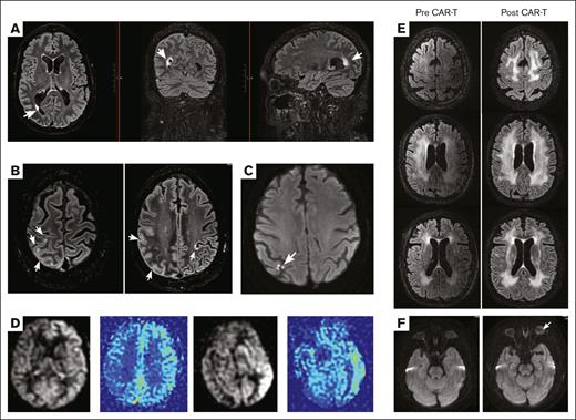 Brain MRI patterns after brexu-cel–associated ICANS. (A) MRI T2 FLAIR sequence showing focal hyperintensity at the right occipital horn. White arrow indicates the area of hyperintensity, visualized across axial (left), coronal (middle), and sagittal (right) cuts. The T2 hyperintense lesion is periventricular and located at the CSF and brain parenchymal border. (B) Additional MRI T2 FLAIR changes seen from patient examined in panel A. There is abnormal T2 hyperintensity and cortical fullness of right hemispheric parietal-occipital gyri. There is 1 area of notable T2 hyperintensity also on the contralateral side seen in the axial image to the right. As arrows indicate, these lesions contour along the meningeal surface of the brain. (C) MRI DWI sequence showing abnormal signal hyperintensity in the posterior right hemisphere. The multipunctate lesion has an atypical appearance at the juxtaposition of 3 cortical gyri and does not follow a specific vascular territory. (D) MRI ASL sequence from 2 patients with ICANS grade 3. Color maps further highlight the asymmetric hyperemia seen in the left hemisphere of both patients. (E) MRI T2 FLAIR sequence from a patient with preexisting white matter disease who then experienced grade 3 ICANS. The extension of white matter T2 hyperintensity increases between baseline before treatment (left column) and after treatment during ICANS (right column). Column images are axial views and arranged from rostral to caudal. (F) MRI DWI sequence from the same patient as in panel E, who experienced acute visual changes during grade 3 ICANS and found to have bilateral optic disk edema. White arrow indicates subtle increase in optic nerve DWI signal, left greater than right, that is seen in the postinfusion axial sequence (right) compared with baseline scan (left).
