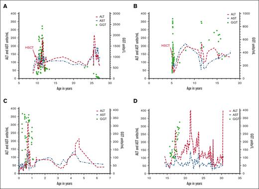 Individual changes in liver enzymes in patients with FA. The average of 3 values for ALT (U/mL) and AST (U/mL) graphed against the patient’s age in years using a fourth-order smoothing polynomial. Actual values of GGT (U/L) were plotted against the patient’s age in years (green). Shown are representative examples of changes in ALT (U/mL), AST (U/mL), and GGT (U/L) in (A) a patient who received HSCT at age 10.3 years; and (B) a patient who received HSCT at age 5.1 years. (C) A patient who never received HSCT and had liver enzyme elevations starting at birth. (D) A patient who had received androgen therapy and liver enzyme abnormalities were first observed at age 14.3 years.