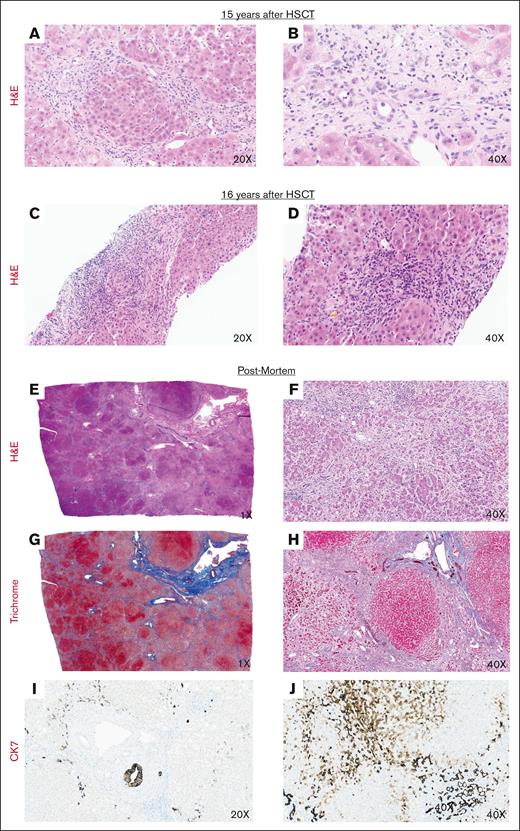 Liver biopsy and postmortem findings in a recipient of HSCT with FA and with PLI. Shown are representative images from serial liver biopsy samples and postmortem analysis of liver sample in a recipient of HSCT with FA and with PLI. The patient had a liver biopsy at 15 years after HSCT to investigate transaminitis. (A-B) H&E staining shows inflammation of the portal tracts with associated cholangitis and pericholangitis and reactive changes in the bile ducts. Bridging fibrosis and focal nodule formation are seen. The patient had a repeat liver biopsy at 16-years post-HSCT. (C-D) Hematoxylin and eosin staining demonstrates acute cholangitis and pericholangitis with lobular cholestasis. Extensive fibrosis of the portal tracts is again seen. Postmortem examination of the liver, 1 year later (E-F) shows marked nodular hyperplasia, fibrosis, and ischemia. The portal tracts show reactive expansion secondary to mononuclear infiltrates and associated cholangitis and pericholangitis. (G-H) Trichrome staining shows portal to portal bridging fibrosis with a prominent perisinusoidal component. (I-J) CK7 immunostaining shows ductular proliferation with ectopic staining of hepatocytes.