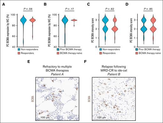 BCMA-expression profiles of plasma cells. (A-B) BCMA expression measured as a percentage of total plasma cell BCMA expression comparing (A) teclistamab nonresponders and responders and (B) patients with and without prior anti-BCMA exposure. (C-D) Plasma cell BCMA expression measured by BCMA staining intensity by IHC (scale, 0-3) comparing (C) teclistamab nonresponders with responders, and (D) patients with and without prior anti-BCMA exposure. (E-F) Pretreatment bone marrow biopsies showing positive BCMA staining (brown) by IHC for representative patients including (E) a patient refractory to both belantamab mafodotin and idecabtagene-vicleucel but responding to teclistamab, and (F) a patient who achieved MRD-CR after idecabtagene-vicleucel now responding to teclistamab after relapse. CR, complete response; MRD, minimal residual disease.