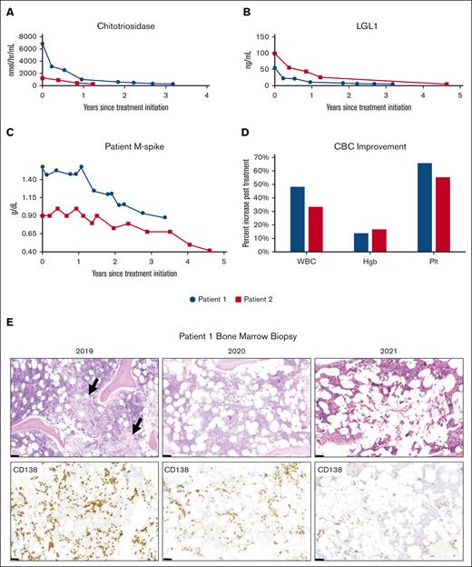 Clinical response to GD1 therapy. (A-C) Laboratory response after initiation of Gaucher disease therapy in patient 1 (blue) and patient 2 (red) as assessed by chitotriosidase (A), LGL-1 (B), and serum M-spike (C). (D) Hematologic improvement after initiation of GD1 therapy. (E) Bone marrow biopsies pretreatment (2019) and posttreatment (2020, 2021); hematoxylin and eosin stain (upper panels) and CD138 immunohistochemical stain highlighting plasma cells (lower panels). Arrows indicate aggregates of atypical macrophages with fibrillar cytoplasm typical of “Gaucher cells.” Scale bar represents 50 μm. A marked reduction in plasma cells is seen after GD1 treatment. Chitotriosidase is measured in nmol/hr/mL. Hgb, hemoglobin; LGL1, plasma lysoglucosylceremide, (ng/mL); M-spike, monoclonal spike (g/dL); Plt, platelet; WBC, white blood cell count.