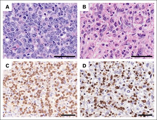 Light microscopy images of EBV+ nPTCL. Hematoxylin and eosin staining and EBV-encoded small RNA (EBER) ISH were performed to examine nuclear morphology, revealing a (A) centroblastoid (UPN857) or (B) pleomorphic appearance (UPN317). (C-D) Tumor cells are positive for EBER (C, UPN857; D, UPN317). Scale bar, 50 μm.