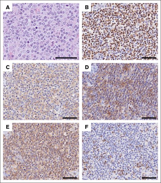 Morphological and phenotypic features of UPN257. (A) Tumor cells are medium to large in size and have a centroblastoid appearance. They are positive for (B) EBV-encoded small RNA (EBER), (C) PD-1, (D) ICOS, and (E) CD4, but negative for (F) TIA-1. Scale bar, 50 μm.