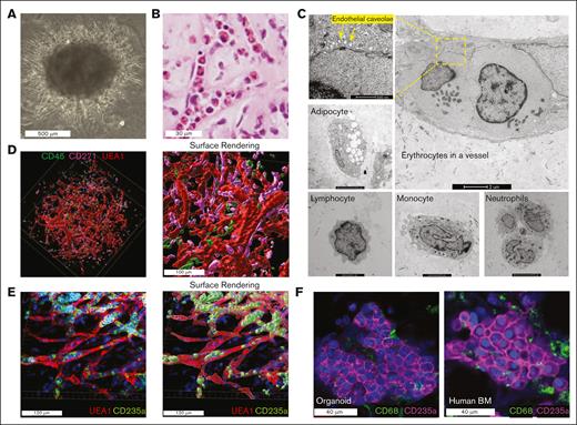 Human iPSC-derived bone marrow organoid mimics human bone marrow structure. (A) Wide-field picture of a mature human bone marrow organoid in culture on day 21. (B) Hematoxylin and eosin (H&E) staining of bone marrow organoid cultured on day 21 demonstrates the presence of hematopoietic cells within the sinusoids. (C) Representative pictures of TEM reveal diverse cell types within bone marrow organoids cultured on day 21. (D) 3D whole-mount imaging of human bone marrow organoids cultured on day 21 (left) with the cell surface rendered via Imaris (right). Organoids were immunostained for CD45+ hematopoietic cells and CD271+ mesenchymal stromal cells, with biotinylated UEA1 highlighting the endothelial cells. (E) 3D imaging reveals erythroblasts, stained for CD235a, encapsulated within UEA1-positive sinusoidal vessels (left). The cell surface rendering picture is on the right. (F) Comparison of confocal images between organoid-derived erythroblasts (day 21 culture) and those obtained from a human bone marrow core biopsy.