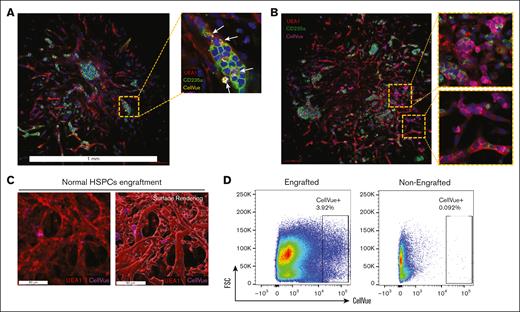 Donor HSPCs engraft within the bone marrow organoids. (A) Confocal imaging demonstrates engraftments of CellVue-labeled donor cells: 5 × 103 CellVue-labeled CD34+ HSPCs derived from a normal bone marrow sample were coincubated with an organoid in a 96-well plate for 3 days before imaging. Arrows indicate CellVue+ cells reside within an erythroid island. (B) Confocal imaging demonstrates engraftments and focal proliferation of CellVue-labeled donor cells: 5 × 103 CellVue-labeled CD34+ HSPCs derived from a normal bone marrow sample were coincubated with an organoid in a 96-well plate for 3 days before imaging. Scale bar, 100 μm. (C) 3D imaging reveals HSPCs from normal bone marrow samples engraft within the vascular niches of organoids. (D) Flow cytometry analysis of organoids engrafted with CellVue-labeled HSPCs, as in panel A. Ten organoids were pooled together for each flow cytometry assay. Non-engrafted organoids were used as controls.