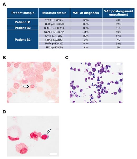 The engraftment-derived hematopoietic cells retain the genetic and morphologic profiles of the donor cells. (A) Whole-exome DNA sequencing of engraftment-derived hematopoietic cells from day 10 after engraftment. Three patients with MDS with the indicated mutations during diagnosis were analyzed. (B) Prussian blue staining of the bone marrow smear sample from patient B2 during diagnosis. (C) Wright-Giemsa staining of the cytospin sample from organoids on day 10 after engraftment with CD34+ HSPCs from patient B2. (D) Prussian blue staining of the cytospin sample from organoids on day 10 after engraftment with CD34+ HSPCs from patient B2. Scale bars, 10 μm. ND, not detected; VAF, variant allele frequency.