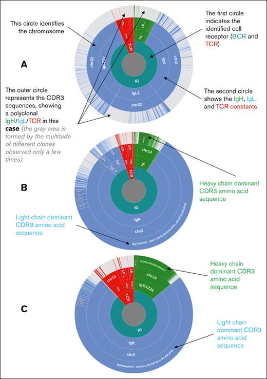 Immunoglobulin and TCR profiles of representative samples (donut charts). The immunoglobulin and TCR sequences are clustered according to the amino acid sequence of CDR3. The BCR or TCR origin (green: IgVH (IgH); blue: IgVL (IgL); red: TCR), identified constant, chromosomal origin, and cluster of identical CDR3 sequences are indicated from the inside to the outside. The 3 samples presented correspond to the 3 different types of 5′RACE results, namely (A) a PMBL case with a polyclonal profile with no dominant clonotype identified. The ratio of B-cell to T-cell (B/T) sequences and the percentage of sequences corresponding to the dominant CDR3s are as follows: B/T ratio, 93.64%; most frequent IgVH CDR3, 0.92%; most frequent IgVL CDR3, 1.48%. (B) A PMBL case with confirmed B-cell clonality, not classified as having the HCD (non-HCD). The clonality threshold was defined as 6.04%; the upper outlier of the distribution of sequencing reads coding the most frequent CDR3 from the heavy and light BCR chains in the absence of tumoral populations. The ratio of B/T sequences and the percentage of sequences corresponding to the dominant CDR3s are as follows: B/T ratio, 94.85%; most frequent IgVH CDR3, 44.74%; most frequent IgVL CDR3, 78.44%. (C) A PMBL case with the HCD in which the dominant clonotype represents >81.1% and >78.6% of all CDR3 sequences for IgVH and IgVL, respectively. The ratio of B/T sequences and the percentage of sequences corresponding to the dominant CDR3s are as follows: B/T ratio, 88.5%; most frequent IgVH CDR3, 93.35%; most frequent IgVL CDR3, 94.42%. HCD, highest clonal dominance.
