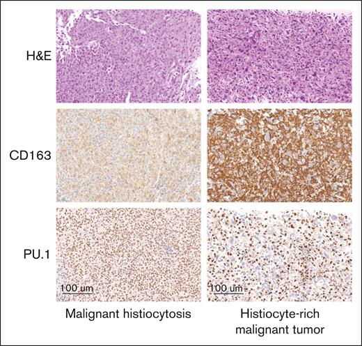 Histological review of referred malignant histiocytoses. Left: liver infiltration by MH, secondary to a large B-cell lymphoma. Tumoral cells only had a weak cytoplasmic staining with CD163 but had a strong nuclear positivity with PU.1. Right: mass involving adrenal glands referred as histiocytic sarcoma. Massive infiltration by reactive DCs with strong CD163 expression, and it was difficult to see that tumor cells were negative. This contrasts with obvious negativity of tumor cells with PU.1. All pictures (original magnification ×300). DC, dendritic cell; H&E, hematoxylin and eosin.