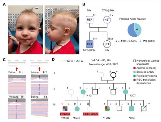 The DBAS8 case with proband carrying the RPS7 variant and the maternal segregation studies. (A) Case 1 (DBAS8) proband at the age of 16 months. (B) The WGS depth and variant allele fractions (AF) in heterozygous subjects revealed by Emedgene software. (C) The maternally inherited RPS7 variant viewed by raw reads in IGV software. (D) The maternal 3-generation pedigree with RPS7 genotype/phenotypes and cascade eADA testing values superimposed. WT, wild-type.