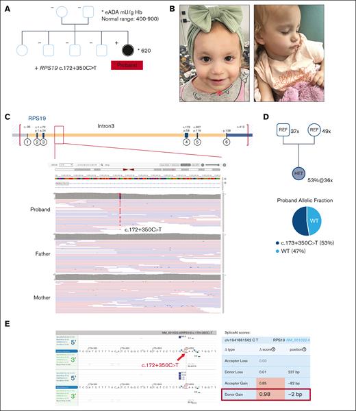 The genomic map of the RPS19 noncoding variant and in silico prediction on splicing impact. (A) The pedigree for the DBAS1/RPS19 family with the eADA level superimposed for the solely affected proband. (B) The DBAS1 proband at the age of 1 year. (C) The genomic position depicting the deep intronic nature of the RPS19 c.172+350C>T variant by IGV. (D) The WGS depth and variant AF in heterozygous subjects. (E) In silico splicing prediction algorithms (Alamut and SpliceAI) independently predicted a profound donor gain (red framed) as a consequence of the deep intronic variant. WT, wild-type.