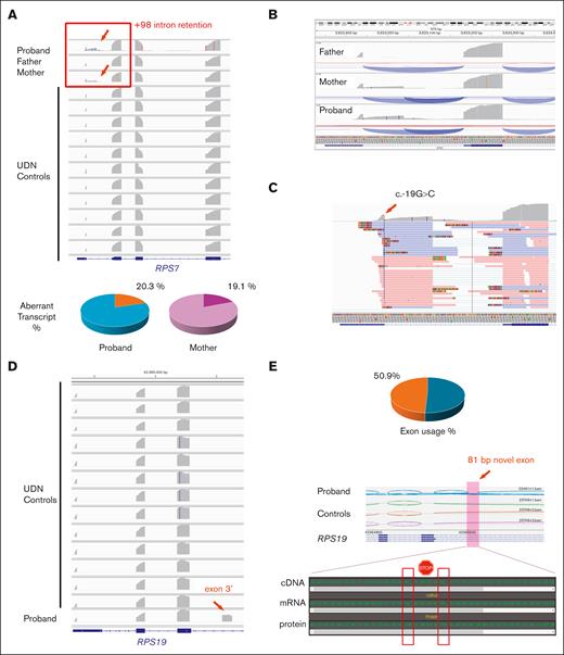 Functional RNA-seq study demonstrated significant transcriptional stability deficiencies for both noncoding variants. (A) For case 2 (DBAS8/RPS7), robust intron retention extending to RPS7 c.-19+98 (red arrow and frame) was revealed in the proband and mother only when compared with father and controls with the aberrant transcript usage rate shown below. (B) Zoomed-in view of the +98 intron retention demonstrating the new transcript usage rate. (C) RNA functional evidence showing that the c.-19G>C variant is confined to those transcripts with retention. (D) For the DBAS1/RPS19 case, a novel exon 3′ (red arrow) immediately upstream of the RPS19 c.172+350C>T variant was identified uniquely in the proband when compared with controls. (E) New exon 3′ usage rate and sequence analysis depicting unique junctional splicing and several stop-gain codons within the 81-bp novel exon 3′. UDN, undiagnosed diseases network.