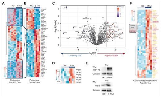 β-thal erythroblasts are characterized by abnormal proteomic signature and increased overall cysteine oxidation, resulting in upregulation of classic chaperones, such as HSP90 and HSP70, and upregulation of antioxidants, such as peroxiredoxins. Proteomics profile of erythroid precursors from patients with β-thal vs HCs. Specifically, the heat maps show the top 500 (A) and 50 (B) significant proteins by t test. (C) The volcano plot indicates proteins whose values are increased (red) or decreased (blue) in β-erythroblasts compared with healthy counterparts. (D) Heat map showing the relative abundance of all peroxiredoxins (Prdx) in the 2 groups. (E) Western blot analysis with specific antibodies against HSP70 and Prdx-2 of erythroid precursors, as in panel A, on day 14 of culture. Catalase was used as loading control. One representative immunoblot of 3 others with similar results. Densitometric analysis is shown in supplemental Figure 2. (F) Heat map showing cysteine redox modifications (colors were coded as follows: oxidation, orange; dioxidation, red; cysteine to dehydroalanine, magenta) between the 2 groups.