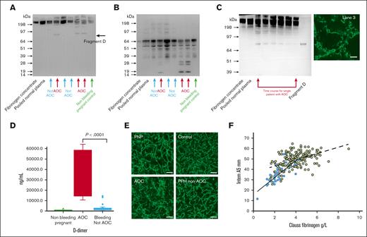 Evidence of fibrinogenolysis and fibrinolysis in AOC. (A) A representative western blot run under nonreducing conditions using an anti-human fibrinogen detection antibody of samples from patients with AOC (red) and severe PPH without AOC (blue); the nonbleeding pregnant control sample (green) was taken before an elective cesarean delivery. Fragment D indicated is a specific marker of fibrinogen proteolysis; fragment Y is ∼160 kDa. (B) A reducing western blot with samples as in panel A, with breakdown products less than ∼30 kDa are detected in AOC but not in PPH without AOC. (C) A representative nonreducing gel of sequential samples over time from a single patient with AOC, revealing fibrinogen in the earliest sample on the left and the latest on the right. A confocal microscopy image of the plasma fibrin clot at the earliest time point (lane 3) is illustrated. (D) D-dimer levels in nonbleeding pregnant controls, AOC, and severe PPH without AOC. (E) Representative confocal microscopy images of plasma fibrin clots for pooled normal plasma (PNP), nonbleeding pregnant control taken before an elective cesarean delivery (control) PPH without AOC (PPH non-AOC), and a case of AOC (AOC). (F) The relationship between Clauss fibrinogen and INTEM A5, as a measure of clot strength, performed on a ROTEM Sigma device. Blue dots are cases of AOC and grey dots of PPH without AOC; individual cases might contribute more than 1 data point. There was no difference in clot firmness, as measured by ROTEM, between the AOC and PPH without AOC groups at similar Clauss fibrinogen levels. Dashed line is the linear correlation for all non-AOC cases (R2 = 0.24), and the solid line is the linear correlation for all AOC cases (r2 = 0.63).