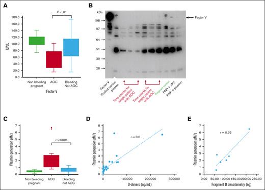 Depletion and proteolysis of FV and enhanced plasmin generation in AOC. (A) FV activity in nonbleeding pregnant controls, AOC, and severe PPH without AOC. (B) FV degradation was analyzed by western blotting. Samples were run under reducing conditions and FV detected by a monoclonal antibody directed to the heavy chain. Two patients with AOC are found to have reduced or undetectable FV compared with PNP and a nonbleeding pregnant control at the time of elective cesarean delivery (illustrated in green). The positive controls are PNP plus activated protein C (aPC) for 15 minutes or PNP plus plasmin for 10 minutes; in both cases, the FV is reduced. (C) Plasmin generation was analyzed in the plasma from the nonbleeding pregnant controls, AOC, and severe PPH without AOC. (D) The relationship between D-dimer and tPA-initiated plasmin generation capacity in all cases of PPH, including AOC and non-AOC cases. (E) The relationship between plasmin generation capacity and the amount of fragment D in the blood of a single patient with AOC at different time points who is described in the case report. Fibrinogen degradation in these patient samples is found in Figure 2C.