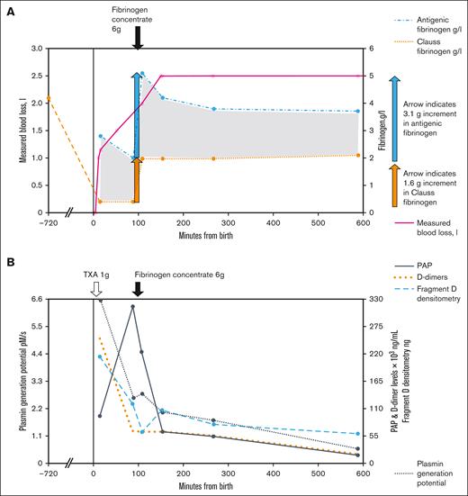 Dynamic changes in hemostatic parameters in the case study of AOC. (A) Clauss and antigenic fibrinogen levels measured during the bleed and the response to an infusion of 6 g of fibrinogen concentrate. The increment for Clauss fibrinogen (orange arrow) is approximately half that found for antigenic (blue arrow). The measured blood loss at the time of each sample is found in pink. (B) The levels of PAP complexes, D-dimer, fragment D, and plasmin generation capacity at each time point. The time of the tranexamic acid (TXA) infusion is illustrated.