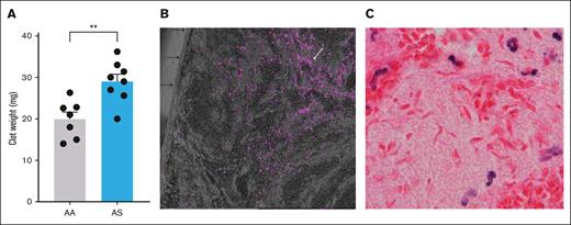 Inferior vena cava thrombi in male AA vs AS mice. (A) Thrombus weight after 24 hours of IVC stasis in AA (n = 7) compared with AS mice (n = 8). (B) Demonstration of severe hypoxia (<10 mm Hg) in the nidus of an IVC clot from a control (AA) mouse, illustrated by the presence of fluorescent cells (white arrow) in the central zone of the thrombus. Individual cells are primarily leucocytes. Black arrows point to the IVC clot surface that abutted the IVC lumen in vivo. (C) Hematoxylin and eosin (H&E) staining showing sickled red cells in the innermost zone of an IVC thrombus from an AS mouse. ∗∗P < .01.