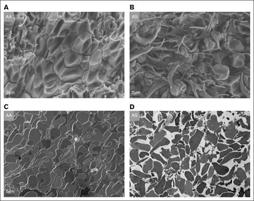 EM images of inferior vena cava thrombi in AA vs AS mice. (A) Typical tightly packed polyhedrocytes in thrombi from AA mice as seen on scanning EM images. (B) In contrast, multiple sickled RBCs with extruding membrane spicules are visible in the core of a thrombus from an AS mouse alongside some nonsickled cells. (C-D) Transmission EM images illustrating tightly packed RBCs (“polyhedrocytes”) in a thrombus from an AA mouse, compared with the loose packing in a clot from an AS mouse. EM, electron microscopy.