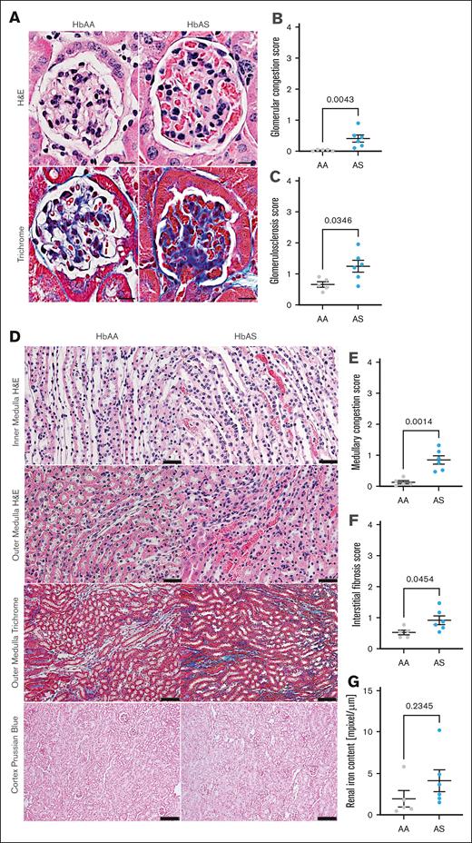 Histological assessment of renal phenotype in male SCT (AS) and genetic control (AA) mice. (A) Representative H&E–stained cortical sections (top; original magnification, 40×; scale bar, 20 μm) and representative Masson trichrome–stained cortical sections of 40-week-old AS and age-matched AA mice (lower; original magnification, 20×; scale bar, 50 μm). (B) Quantification of glomerular congestion score index presented in panel A. (C) Quantification of glomerular sclerosis score index presented in panel A. (D) Representative H&E–stained renal medulla sections of 40-week-old AS and age-matched AA mice (original magnification, 40×; scale bar, 20 μm) and representative Masson trichrome–stained renal medulla sections of 40-week-old AS and age-matched AA male mice (original magnification, 20×; scale bar, 50 μm) and Prussian blue cortical section of 40-week-old AS and age-matched AA mice (original magnification, 10×; scale bar, 100 μm). (E) Quantification of medullary congestion score index presented in panel D; (F) Quantification of medullary interstitial fibrosis index presented in panel D; quantification of iron deposition in the whole kidney sections represented and megapixel per micrometer. In panels B-C and E-G, data are mean ± SEM (n = 5-6 per genotype); analysis by Mann-Whitney nonparametric test, ∗P < .05.