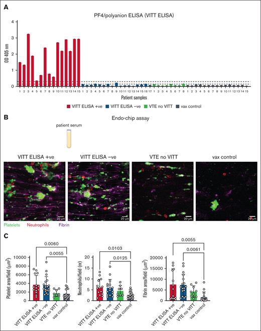 Endothelial thromboinflammation develops in the Endo-chip in response to both VITT ELISA positive and negative sera. (A) Optical density (OD) of VITT samples that tested positive by routine PF4/polyanion ELISA (VITT ELISA positive), and negative by routine PF4/polyanion ELISA (VITT ELISA negative). The OD was also measured for samples from patients with VTE without VITT and in vax controls. The dotted black lines represent the lowest and highest cutoff for positivity determined by the manufacturer. (B) Platelet (green), neutrophil (red), and fibrin (purple) accumulation following a 15-minute blood perfusion in the Endo-chip after treatment with VITT ELISA positive, VITT ELISA negative, VTE without VITT, or vax control sera. Representative images. (C) Platelet fluorescence area per field, neutrophil count per field, and fibrin fluorescence area per field following a 15-minute perfusion of blood in the Endo-chip after treatment with VITT ELISA positive, VITT ELISA negative, VTE without VITT, or vax control sera. VITT ELISA positive n = 15, VITT ELISA negative n = 17, VTE no VITT n = 8, and vax control n = 15. The individual patient numbers are shown in panel A. One-way ANOVA with Dunn post hoc test was used for comparisons.
