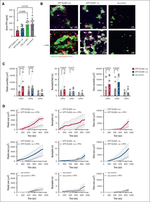 PF4 enhances endothelial thromboinflammation induced by VITT serum in the Endo-chip. (A) Serum concentration of PF4 (ng/mL) in VITT ELISA positive, VITT ELISA negative, VTE without VITT, and vax control samples. One-way ANOVA with Tukey post hoc test was used for comparison. (B) Platelet (green), neutrophil (red), and fibrin (purple) accumulation following a 15-minute blood perfusion in the Endo-chip after treatment with VITT ELISA positive, VITT ELISA negative, or vax control serum without (upper panel) or with (lower panel) the addition of PF4. Representative images. (C) Platelet fluorescence area per field, neutrophil count per field, and fibrin fluorescence area per field following a 15-minute blood perfusion in the Endo-chip after treatment with VITT ELISA positive serum without or with addition of PF4, VITT ELISA negative serum without or with addition of PF4, and vax control serum without or with addition of PF4. A paired t test was used for comparison. (D) Kinetics of the platelet fluorescence area, neutrophil count, and fibrin fluorescence area over 15 minutes of blood perfusion in the Endo-chip after treatment with VITT ELISA positive serum without or with addition of PF4, VITT ELISA negative serum without or with addition of PF4, or vax control serum without or with addition of PF4. VITT ELISA positive n = 7 (patients 1, 2, 4, 5, 6, 8, 11), VITT ELISA negative n = 11 (patients 1, 2, 4, 5, 6, 8, 9, 10, 11, 12, 14), vax controls n = 11 (patients 1, 2, 5, 6, 7, 8, 10, 12, 13, 14, 15). PF4 was added at 25 μg/mL in all experiments.