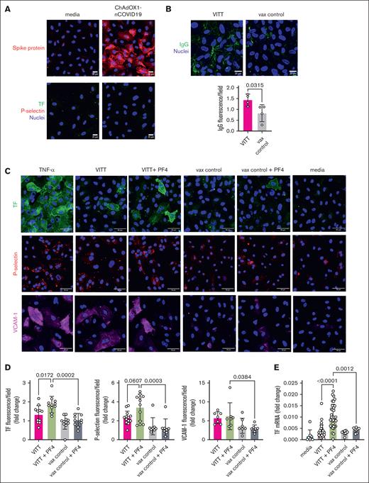VITT serum induces endothelial cell activation, which is enhanced with the addition of PF4. (A) Immunostaining of the HUVEC layer for spike protein (red), nuclei, TF, and P-selectin (lower panel) after incubation with media alone or with media containing ChAdOx1 nCOV-19 adenoviral vaccine. (B) Immunostaining for human IgG (green) in HUVECs after treatment with VITT sera vs vax control sera. Representative images. The fluorescence intensity of IgG per field is shown for VITT and vax controls. Mean ± SD from 3 to 5 fields of view; n = 4 independent experiments, unpaired t test. (C) Representative images of HUVECs stained for TF (green), P-selectin (red), and VCAM-1 (magenta) after exposure to TNF-α (5 ng/mL), VITT serum, VITT serum + PF4 (25 μg/mL), vax control serum, vax control serum + PF4 (25 μg/mL), or media. Nuclear staining using Hoechst is shown in blue. (D) Fluorescence intensity of TF, P-selectin, and VCAM-1 of HUVECS treated with VITT, without or with 25 μg/mL PF4 added, or treated with vax control, without or with 25 μg/mL PF4 added, expressed as fold change in comparison with the fluorescent intensity of media alone. Mean ± SD, from 3 to 5 fields of view; VITT ELISA positive n = 2 (patients 2, 4), VITT ELISA negative n = 2 (patients 3, 9), vax control n = 4 (patients 2, 6, 10, 12). One-way ANOVA with Dunn post hoc test was used for comparison. (E) Fold change in the mRNA expression of F3 (TF) in HUVECs treated with plasma, with or without PF4 (25 μg/mL), in comparison with that of glyceraldehyde-3-phosphate dehydrogenase. Mean ± SD, n = 10 for media, VITT ELISA positive n = 21 (Table 1), VITT ELISA negative n = 17 (Table 1), vax control n = 8 plasma samples. One-way ANOVA with Dunn post hoc test was used for comparisons.