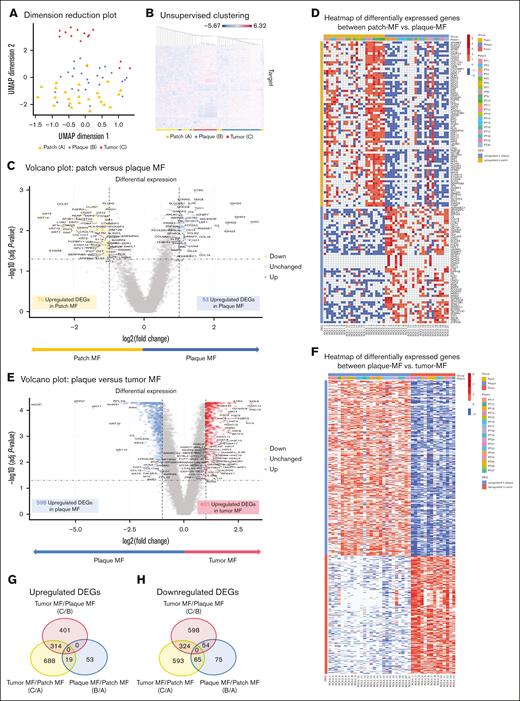 Digital spatial transcriptome analysis revealed that transcriptomic expression differed among patch-, plaque-, and tumor-stage MF. (A) A dimension reduction plot of UMAP showed that patch- (marked in yellow), plaque- (marked in blue), and tumor-stage MF (marked in red) form distinct clusters in the lymphoma cell area. (B) Unsupervised clustering of all genes revealed similar results. Volcano plot showing DEGs with fold changes >2 and P < .05 (C) and heatmap of DEGs (D) in lymphoma cell areas between patch- and plaque-stage MF. Volcano plot showing DEGs with fold changes >2 and P < .05 (E) and heatmap of DEGs (F) in lymphoma cell areas between plaque- and tumor-stage MF. Venn diagram showing common and distinct upregulated (G) or downregulated (H) DEGs among patch-, plaque-, and tumor-stage MF. PT, patient.